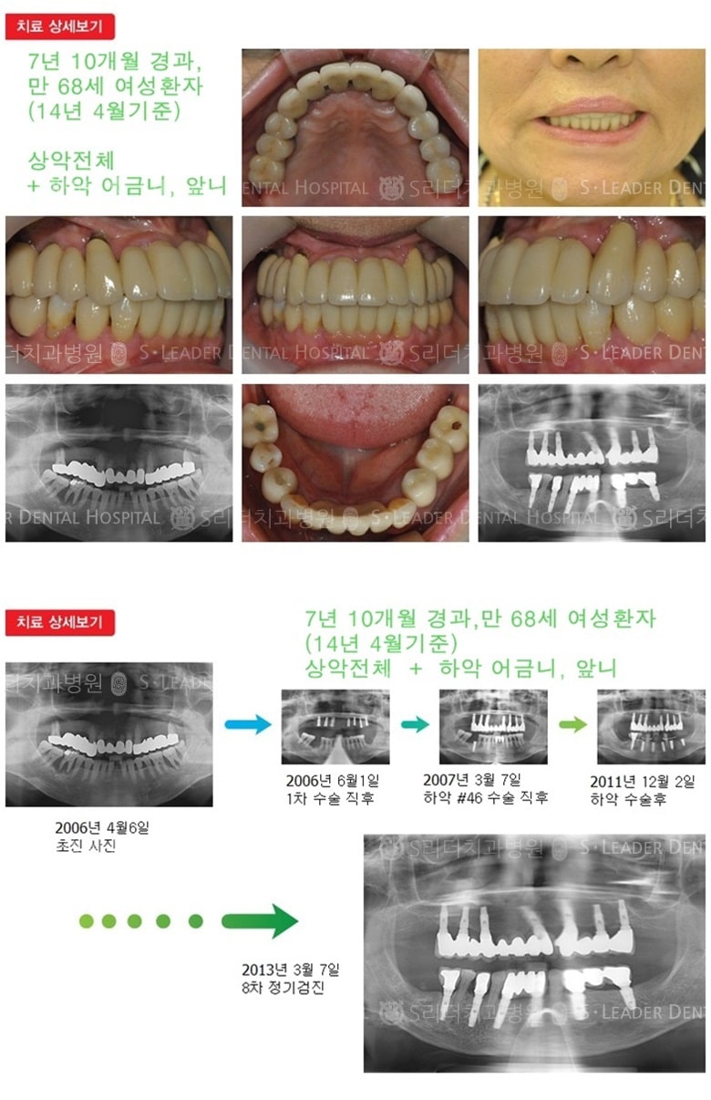 전체임플란트,20년 3개월 — 추가 사진 (임플란트)