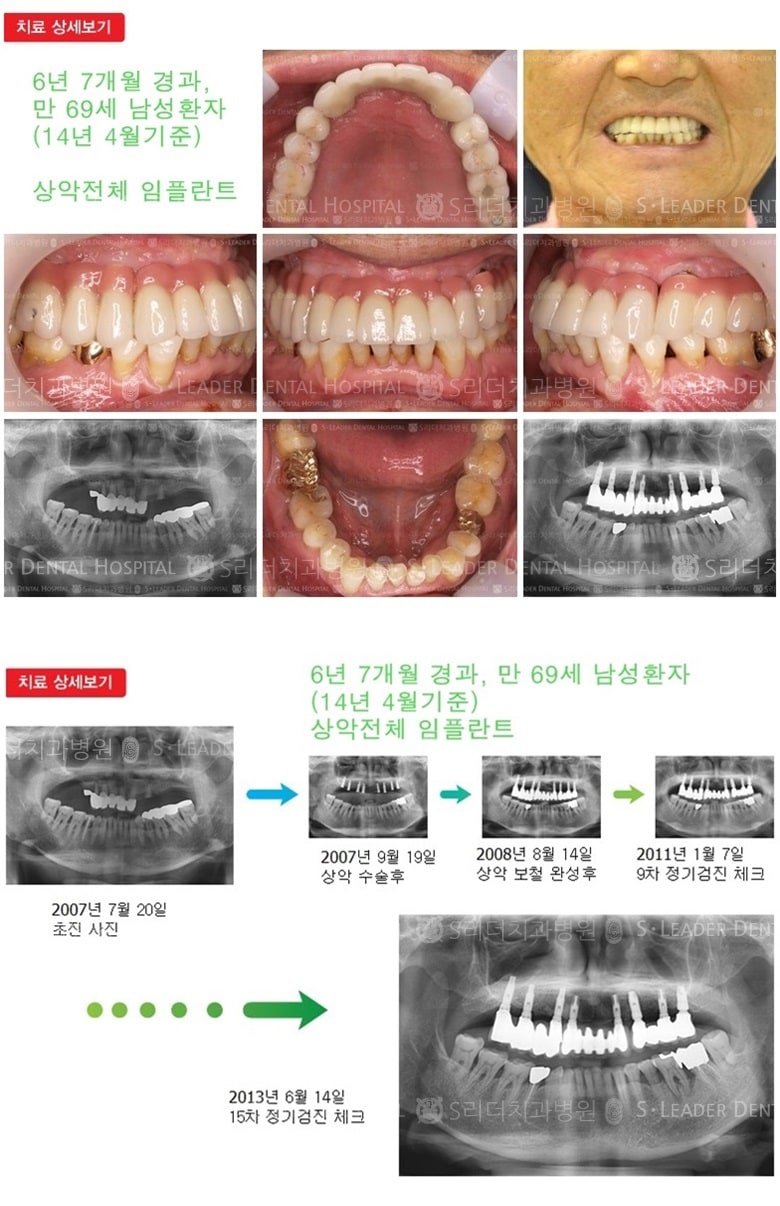 전체임플란트, 19년 경과 — 추가 사진 (임플란트)