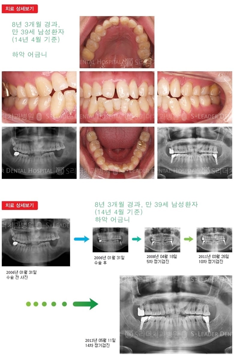 어금니임플란트,30대임플란트,20년 8개월경과 — 추가 사진 (임플란트)