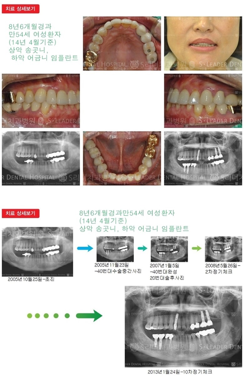 송곳니임플란트,어금니임플란트,20년 11개월 — 추가 사진 (임플란트)