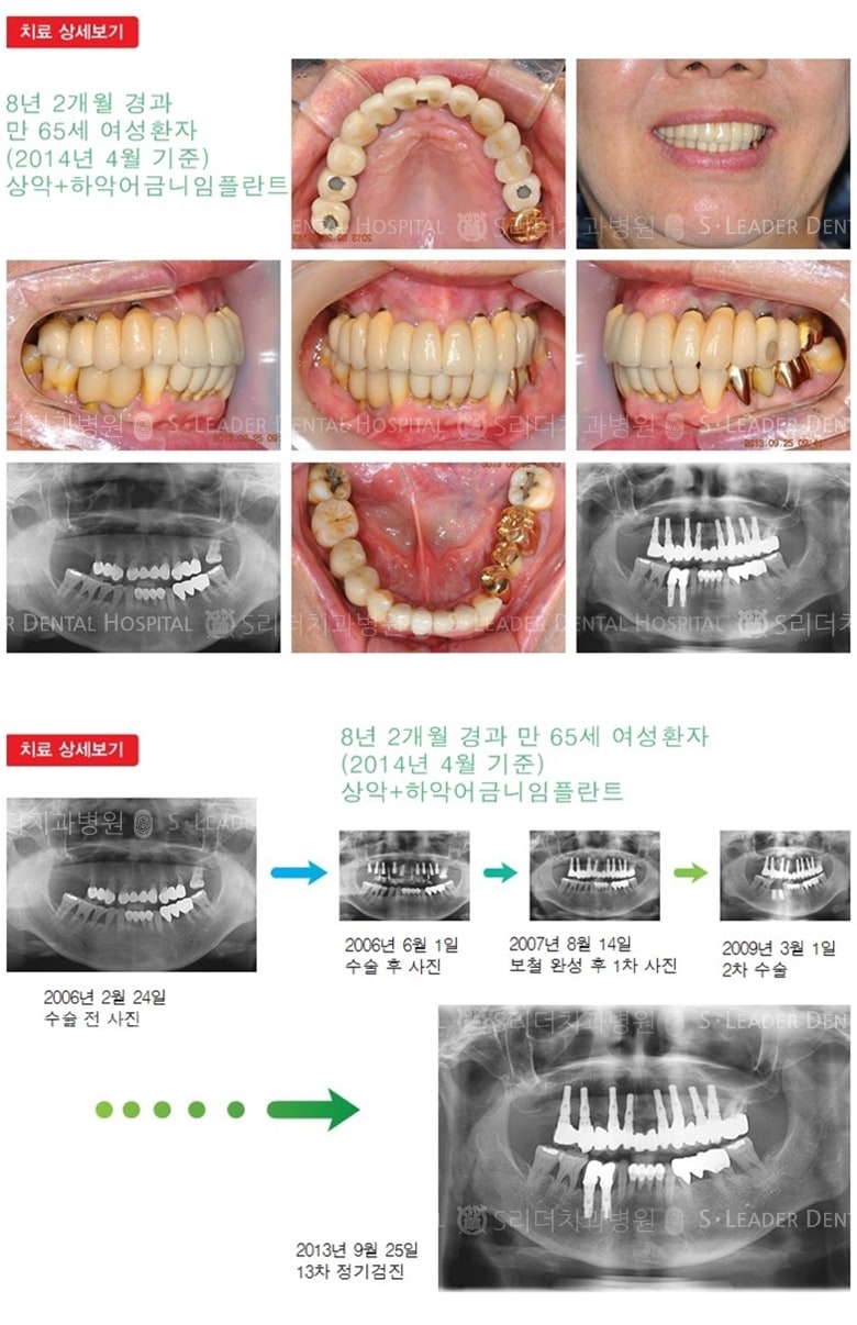 전체임플란트, 20년 7개월 경과 — 추가 사진 (임플란트)