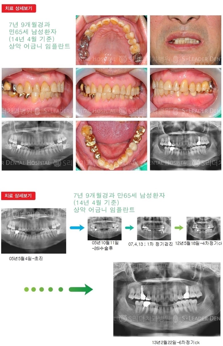 상악 어금니 2개 치료, 20년 2개월 경과 — 추가 사진 (임플란트)