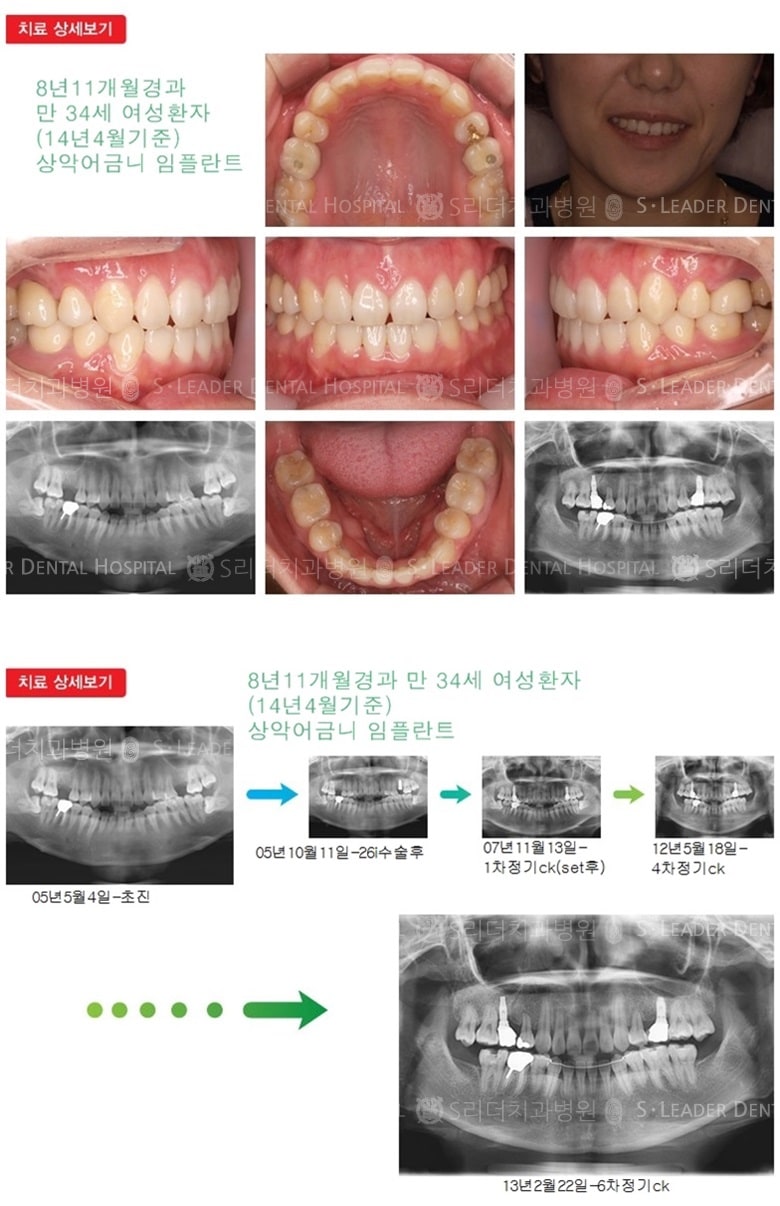 어금니임플란트,30대임플란트,21년 4개월경과 — 추가 사진 (임플란트)