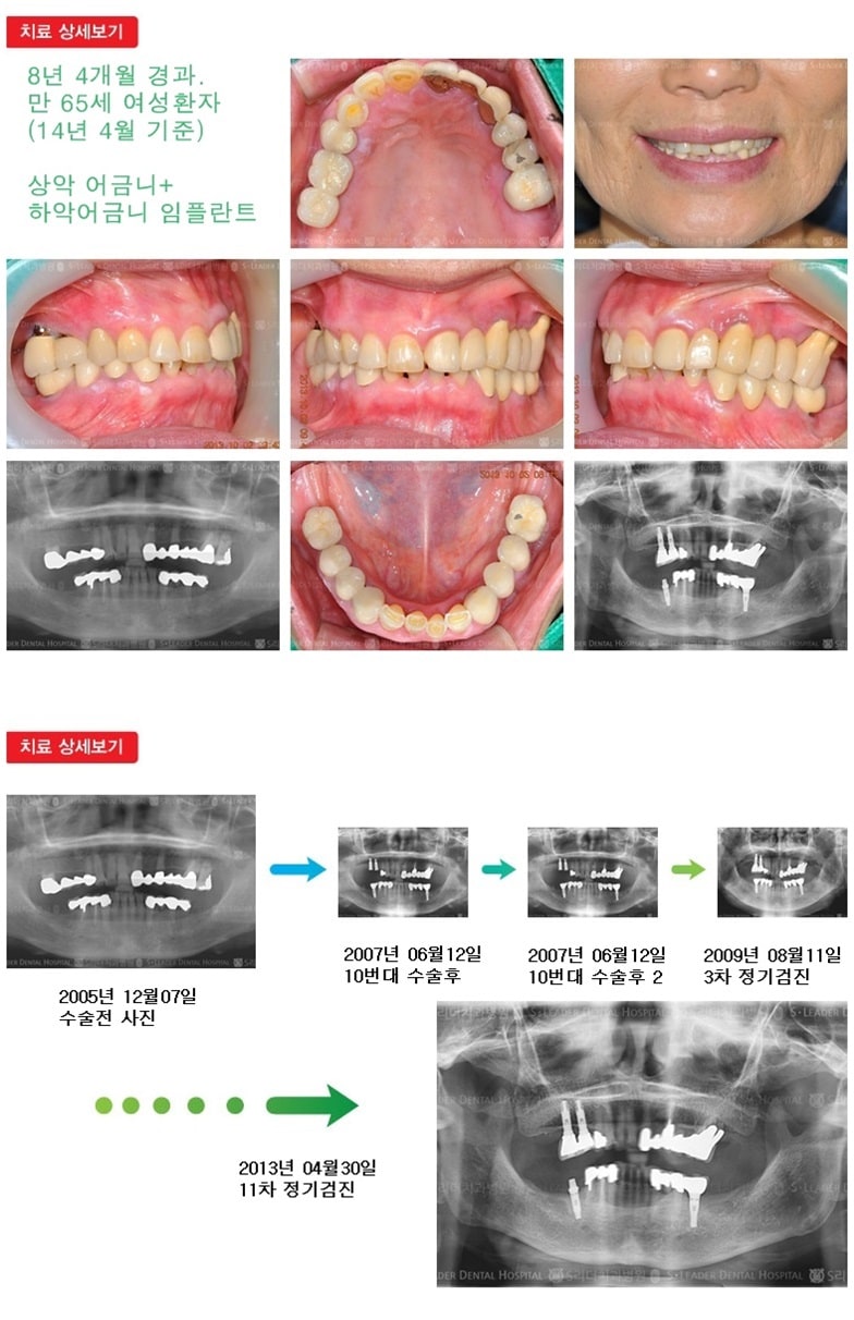 65세이상임플란트,20년 9개월 경과 — 추가 사진 (임플란트)