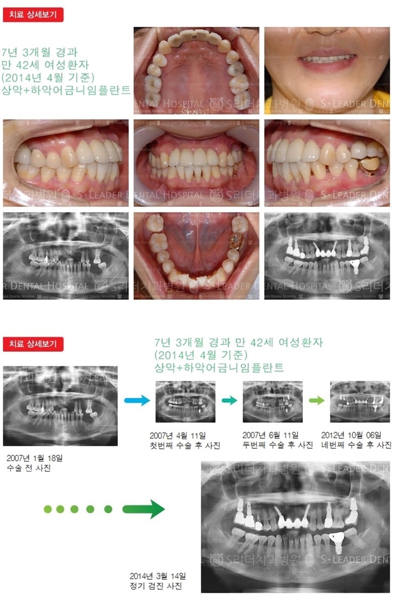 어금니임플란트,앞니임플란트,19년 8개월경과 — 추가 사진 (임플란트)