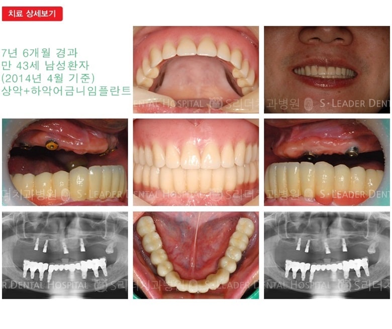 임플란트틀니, 19년 11개월 경과 — 추가 사진 (임플란트)