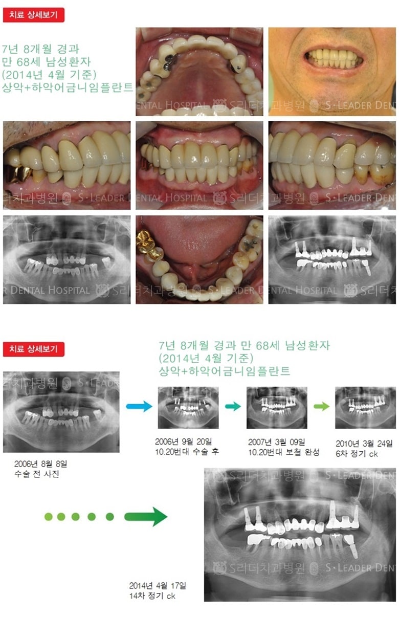 건강보험임플란트, 20년 1개월 경과 — 추가 사진 (임플란트)