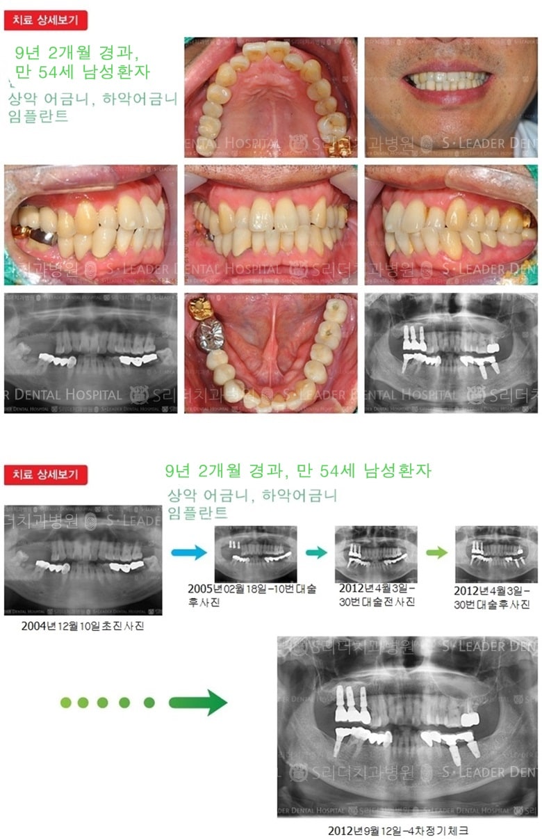 어금니임플란트 21년 7개월 경과 — 추가 사진 (임플란트)