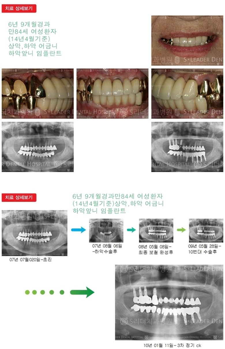 노인임플란트, 만 84세,19년 2개월 경과 — 추가 사진 (임플란트)