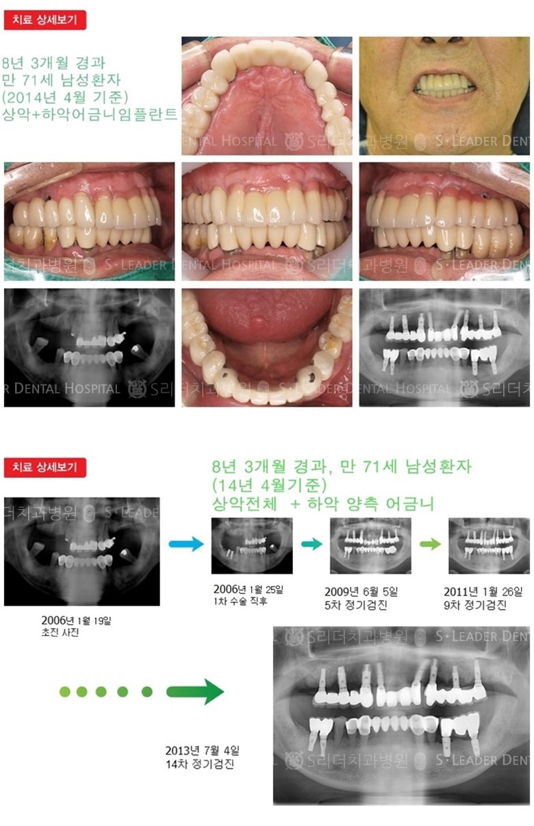 전체임플란트, 20년 8개월 경과 — 추가 사진 (임플란트)