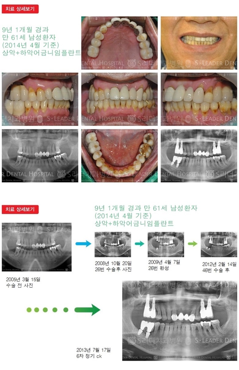 어금니임플란트, 21년 6개월 경과 — 추가 사진 (임플란트)