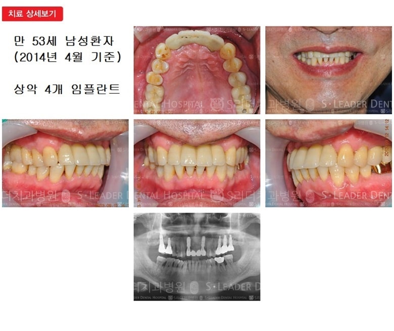 앞니 4개, 만 53세 남성환자 — 추가 사진 (임플란트)