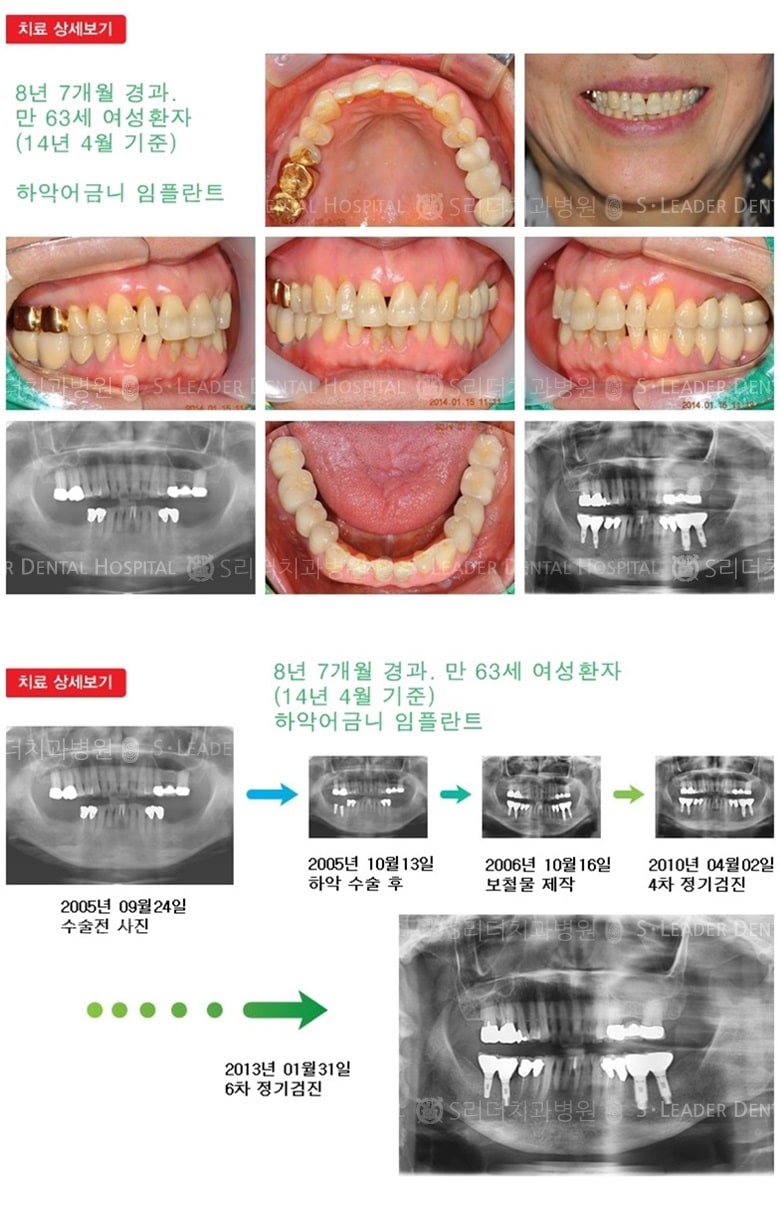 어금니임플란트, 21년 경과 — 추가 사진 (임플란트)