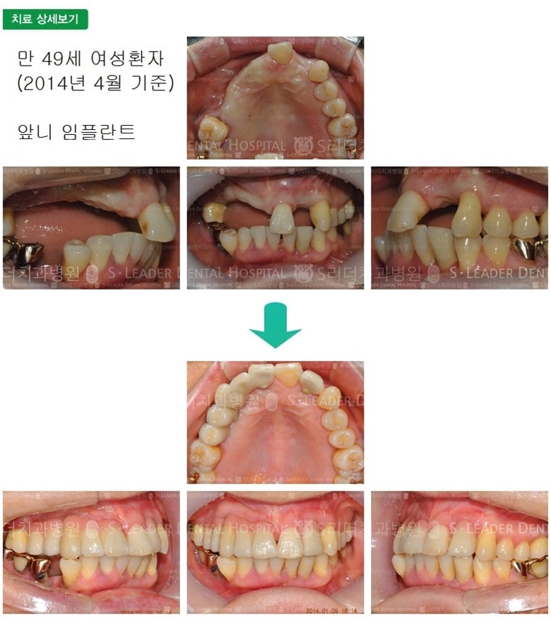 앞니임플란트,잇몸뼈임플란트 — 추가 사진 (임플란트)
