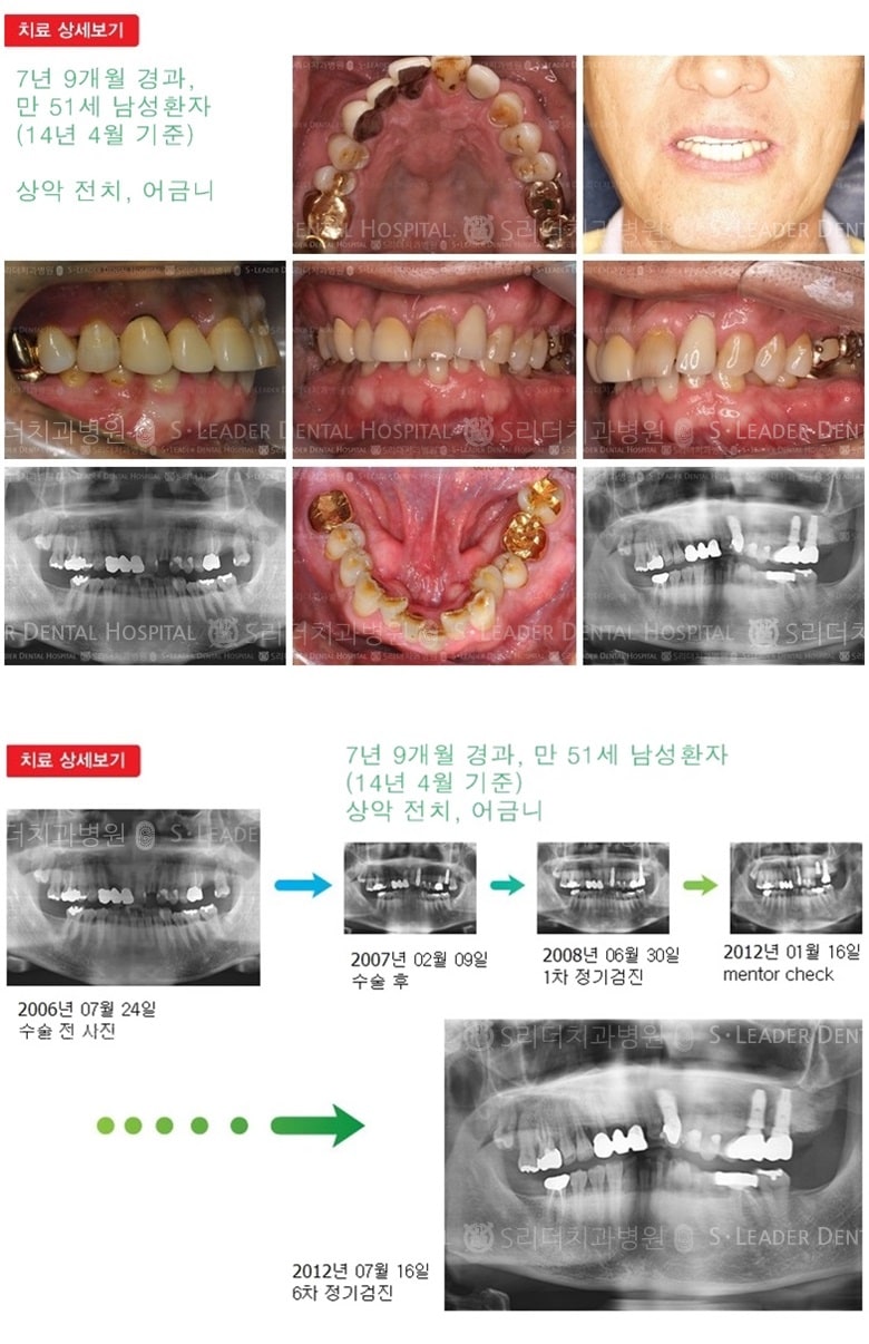 상악 앞니1개 + 어금니2개,20년 2개월경과 — 추가 사진 (임플란트)