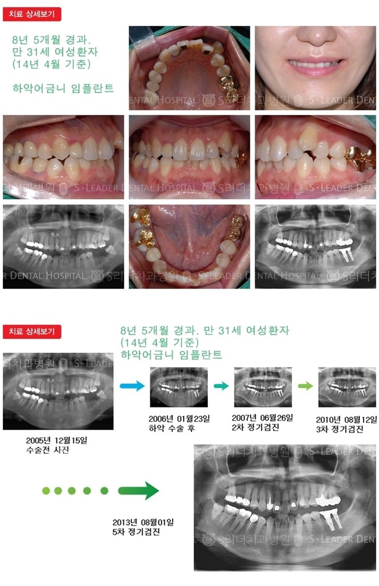 어금니임플란트,30대임플란트,10년 10개월경과 — 추가 사진 (임플란트)