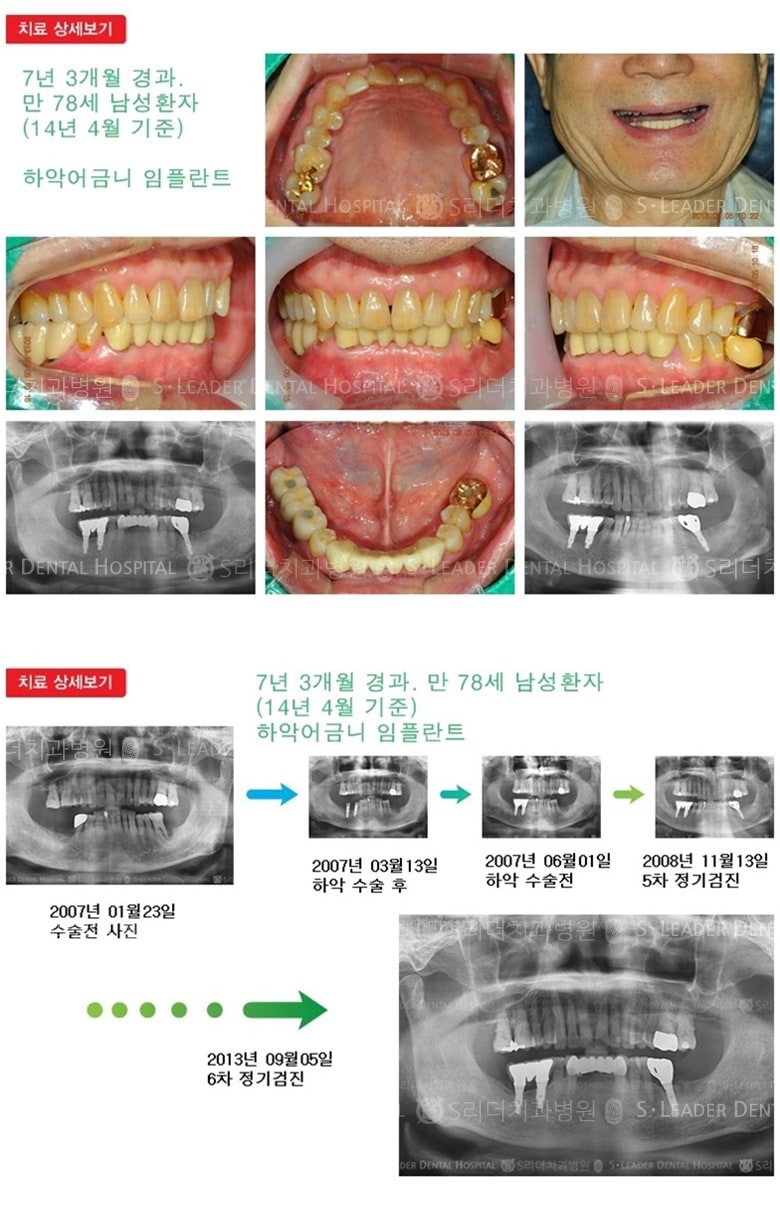 노인임플란트, 만 78세, 19년 8개월경과 — 추가 사진 (임플란트)