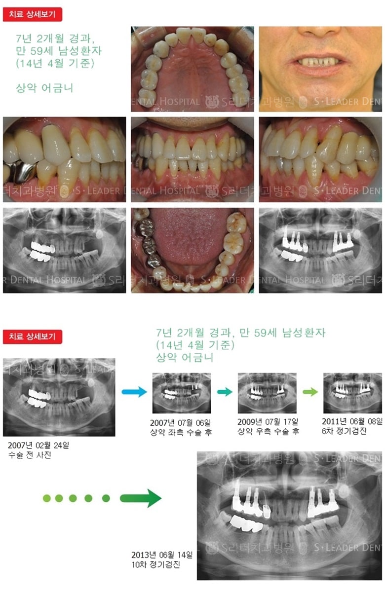 어금니임플란트, 19년 7개월 경과 — 추가 사진 (임플란트)