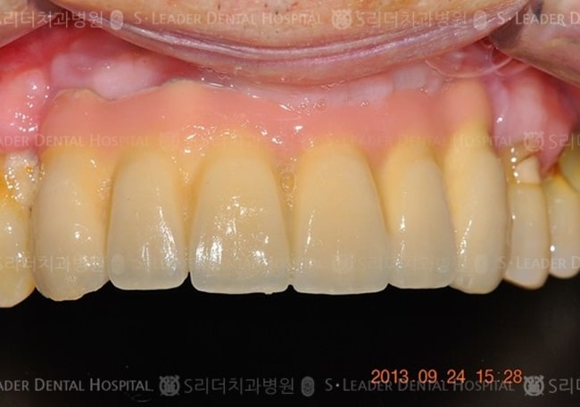 상악 앞니 6개, 15년 6개월 경과 (증례 536)
