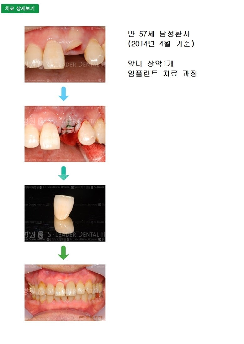 앞니임플란트, 17년 7개월 경과 — 추가 사진 (임플란트)