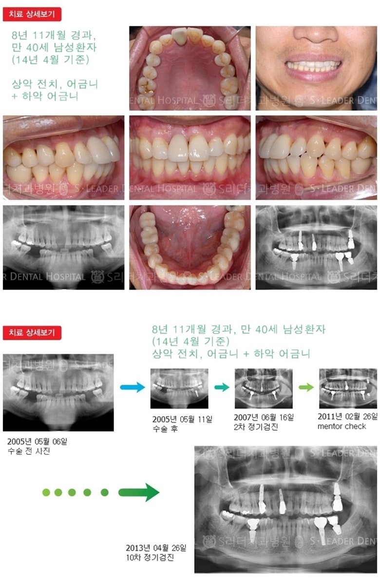 상하악 앞니, 어금니, 21년 4개월 경과 — 추가 사진 (임플란트)