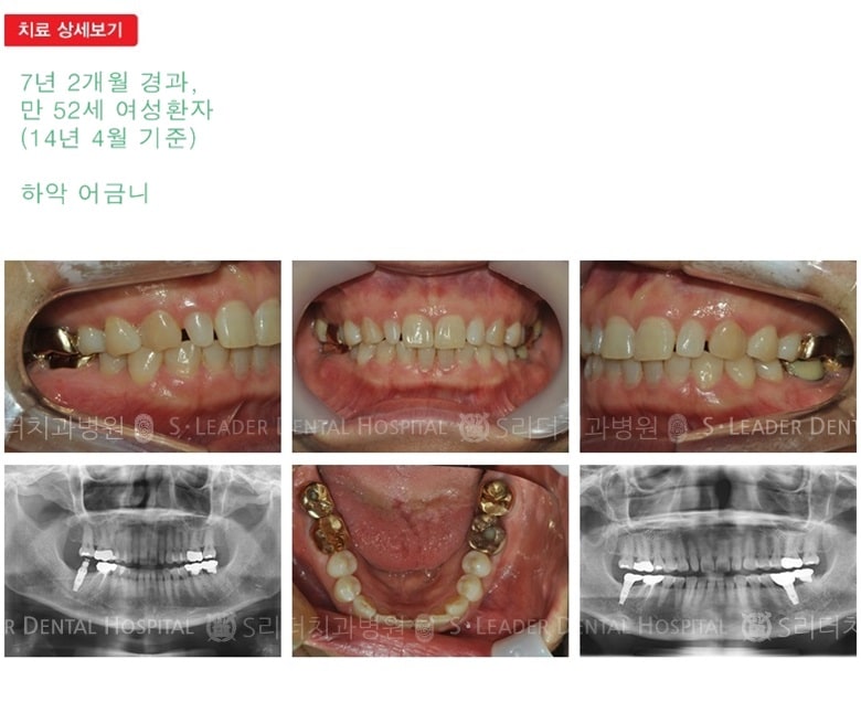 어금니임플란트, 19년 7개월 경과 — 추가 사진 (임플란트)