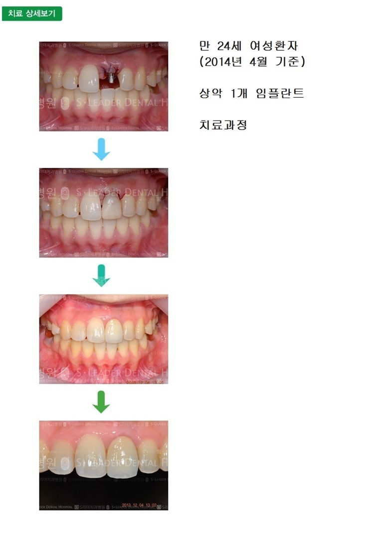 20대임플란트, 앞니임플란트 — 추가 사진 (임플란트)