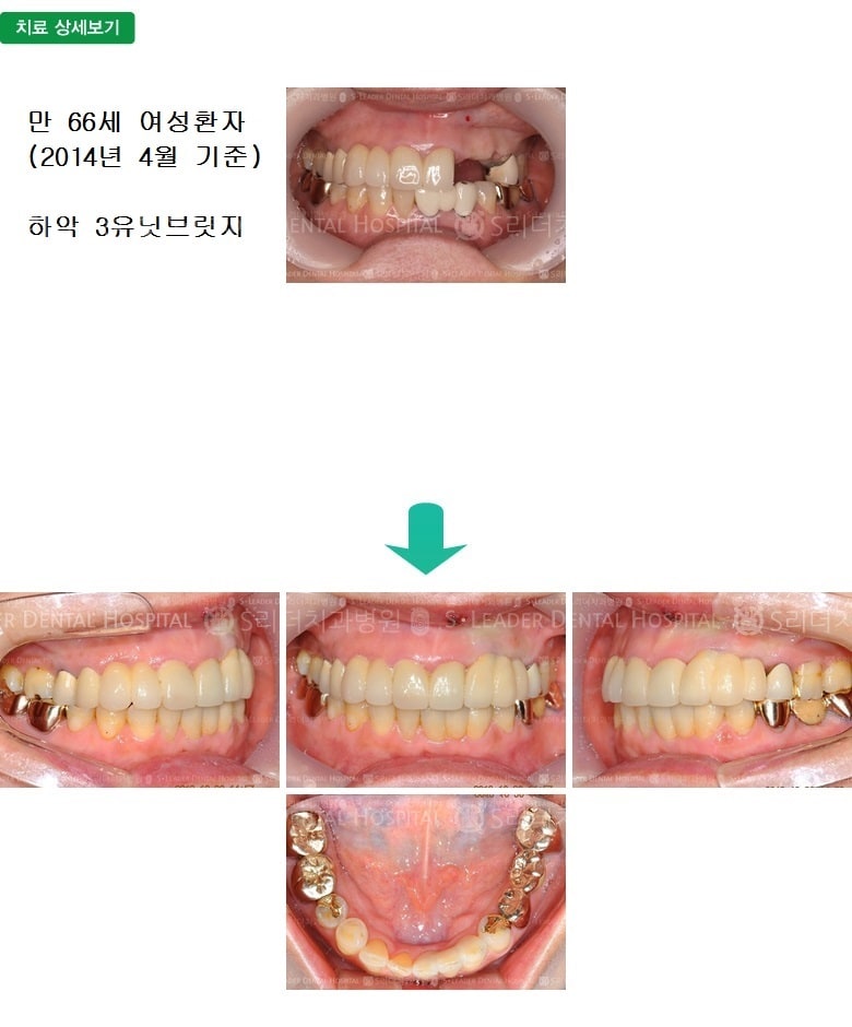 상악 3개(송곳니 포함) 치료, 만 66세여성 — 추가 사진 (임플란트)