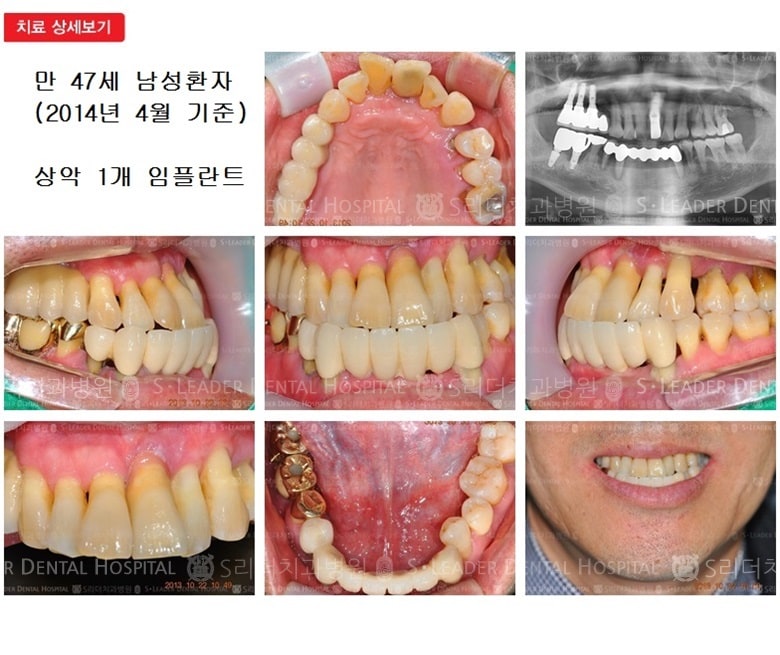 앞니임플란트, 상악 1개, 만 47세 — 추가 사진 (임플란트)