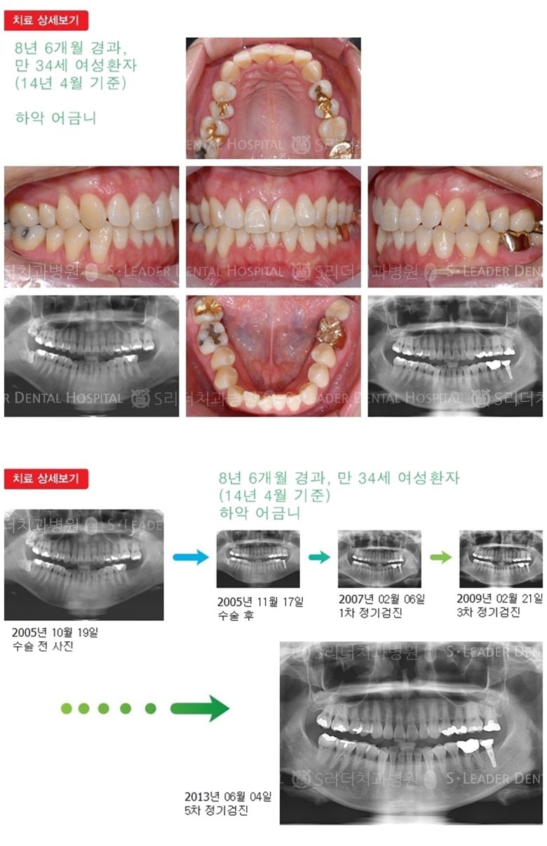 30대임플란트,어금니임플란트,20년 11개월경과 — 추가 사진 (임플란트)