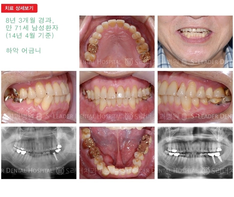 65세이상임플란트, 만71세, 20년 8개월경과 — 추가 사진 (임플란트)