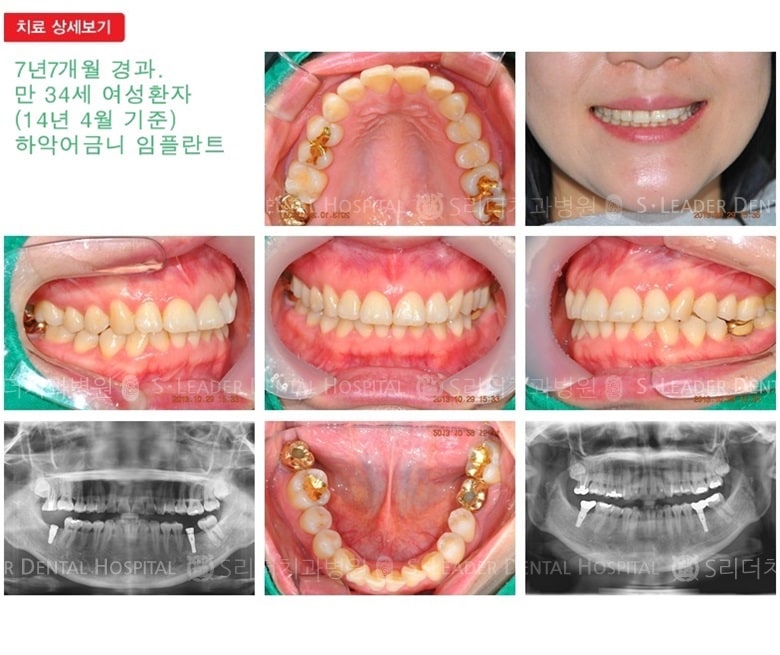 어금니임플란트,30대임플란트,20년경과 — 추가 사진 (임플란트)