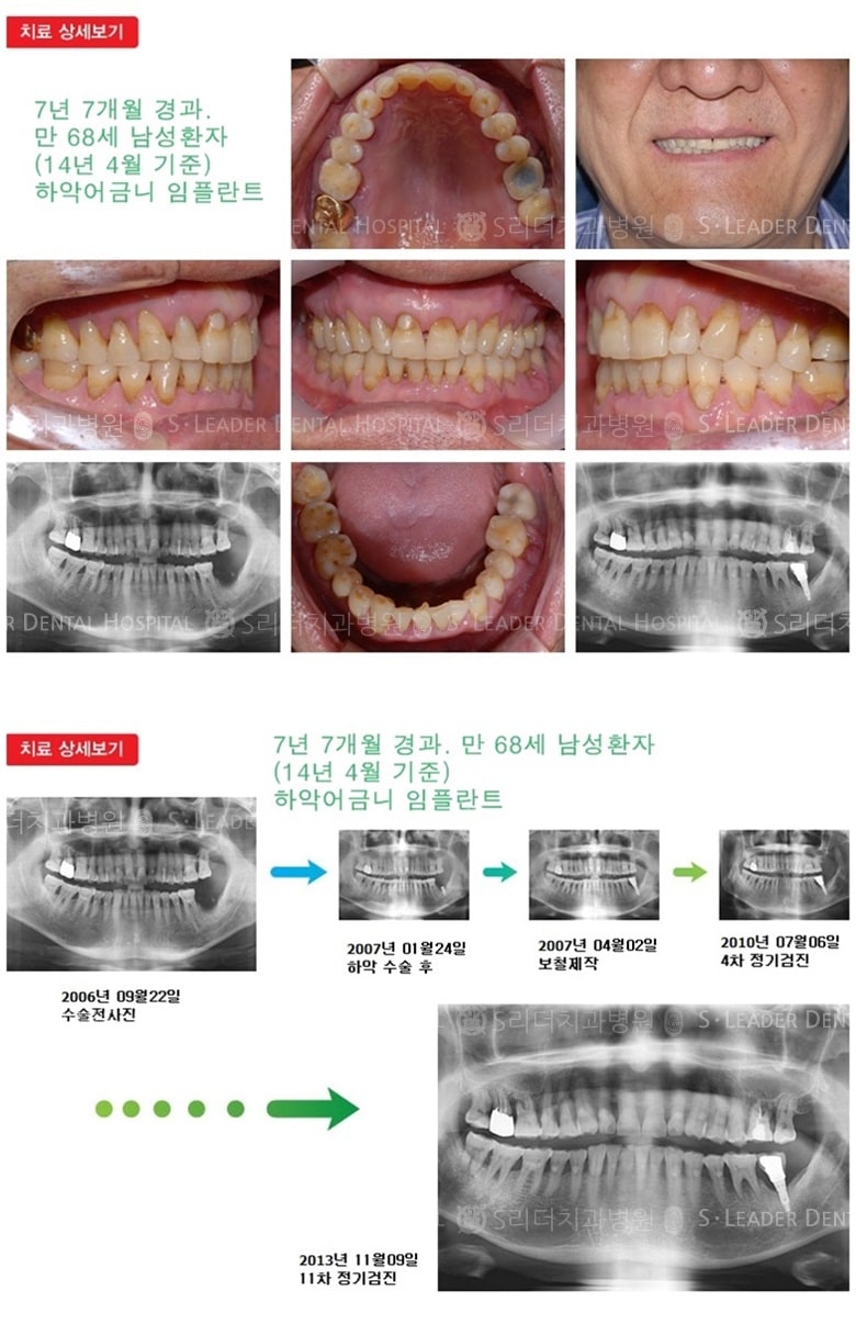 임플란트건강보험, 20년 경과 — 추가 사진 (임플란트)