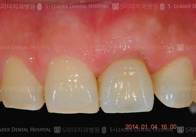 상악 앞니 1개, 17년 4개월 경과 (증례 544)