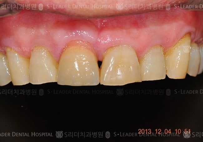 상악 앞니 1개, 15년 5개월 경과 (증례 546)