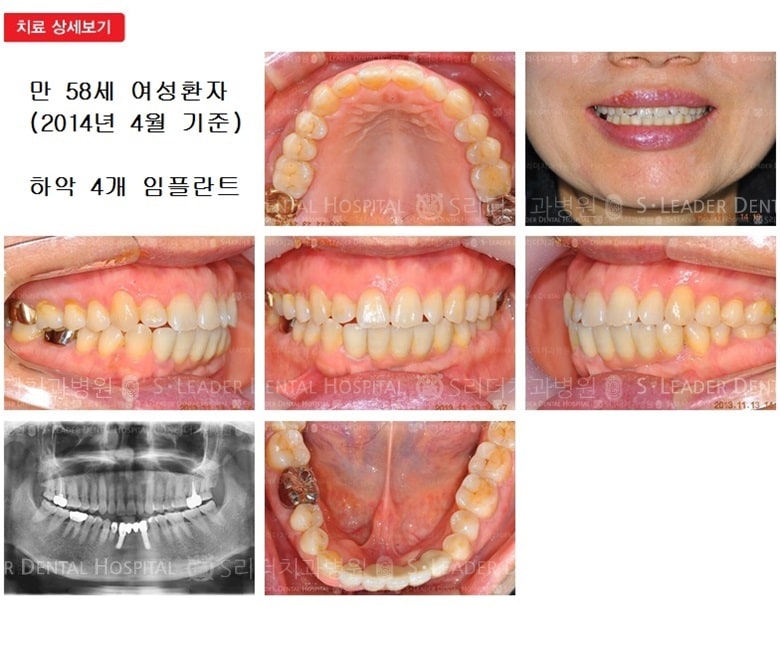 앞니임플란트, 50대임플란트,14년 9개월 경과 — 추가 사진 (임플란트)
