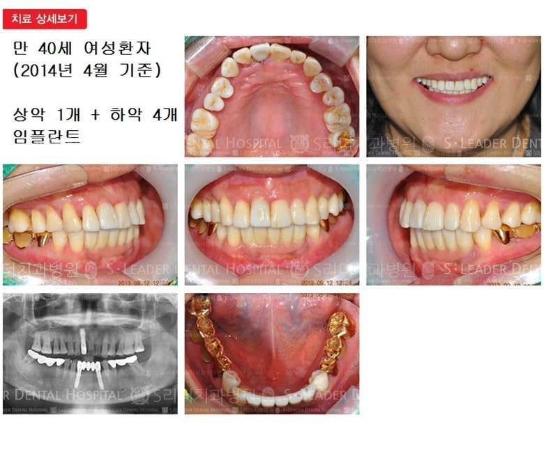 앞니임플란트, 40대임플란트, 15년 5개월 경과 — 추가 사진 (임플란트)