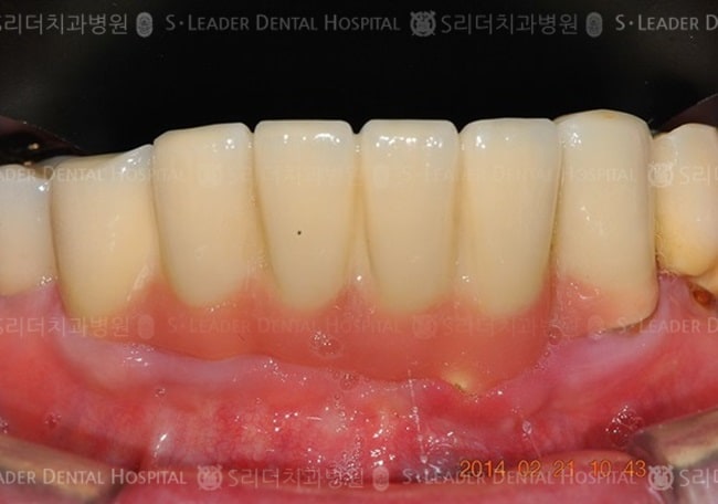하악 앞니 6개 + 상악 앞니 6개 치료사례 (증례 550)