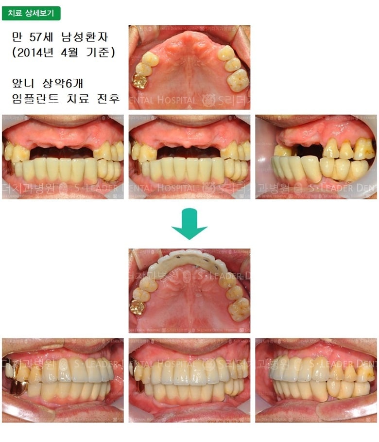 하악 앞니 6개 + 상악 앞니 6개 치료사례 — 추가 사진 (임플란트)