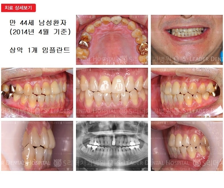 상악 앞니 1개, 13년 11개월 경과 — 추가 사진 (임플란트)