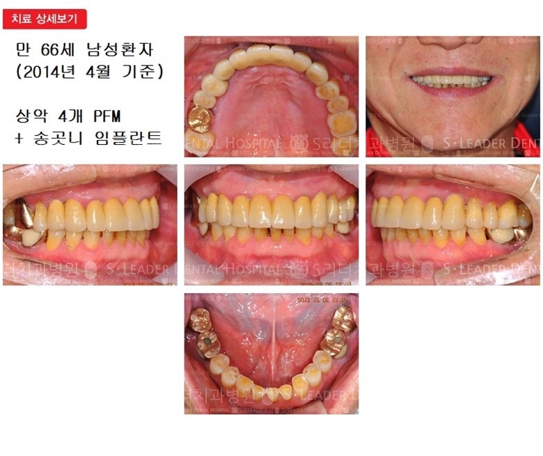 송곳니 임플란트 + 앞니 4개 PFM 케이스 — 추가 사진 (임플란트)