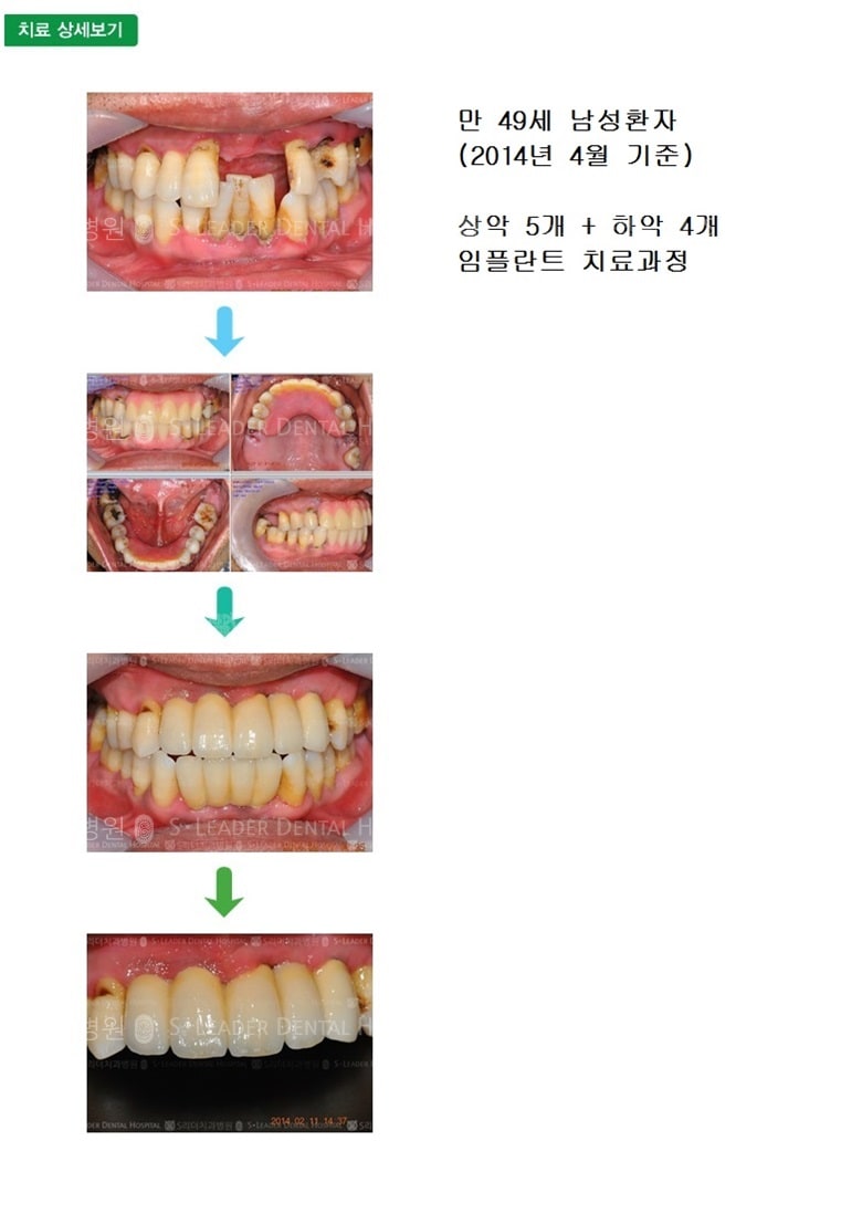 하악 앞니 4개, 만 49세 남성환자 — 추가 사진 (임플란트)