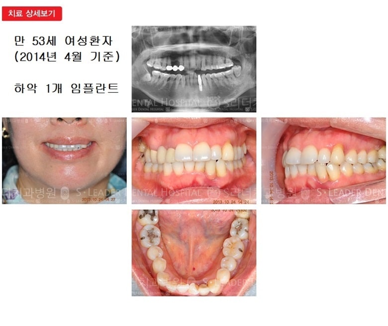 하악 앞니 1개, 18년 1개월 경과 — 추가 사진 (임플란트)