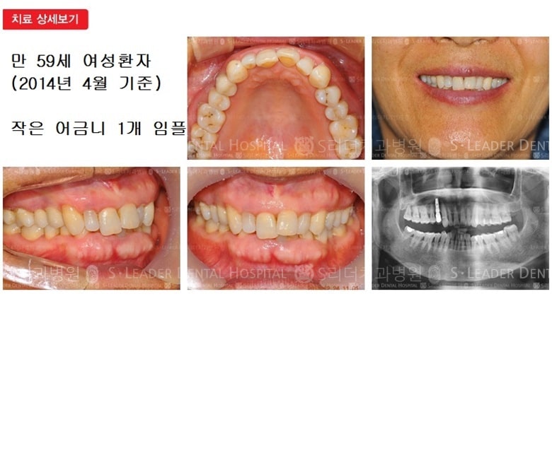 작은어금니임플란트, 17년 5개월 경과 — 추가 사진 (임플란트)