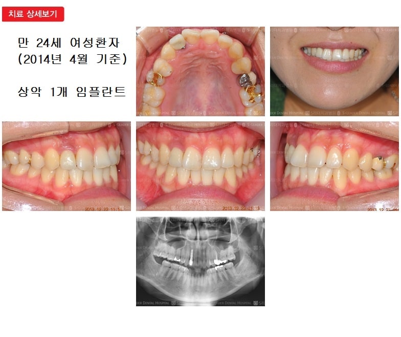 상악 앞니 1개, 15년 5개월 경과 — 추가 사진 (임플란트)