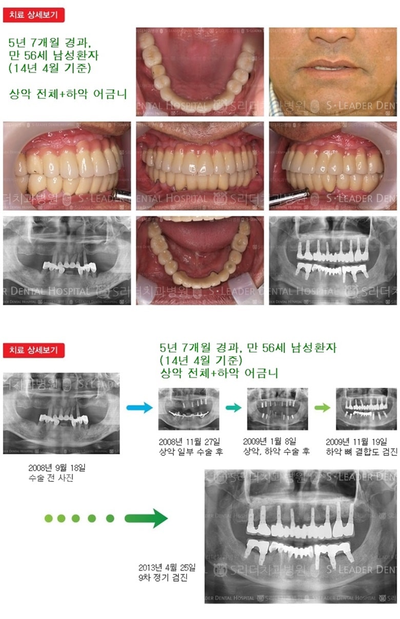 상악 전체 + 하악 어금니,18년 경과 — 추가 사진 (임플란트)