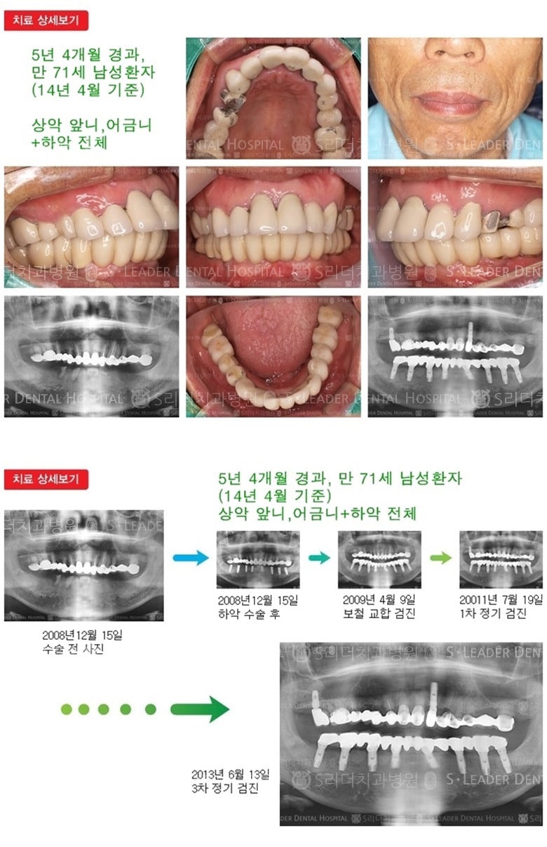 하악 전체 + 상악 2개,17년 9개월 경과 — 추가 사진 (임플란트)