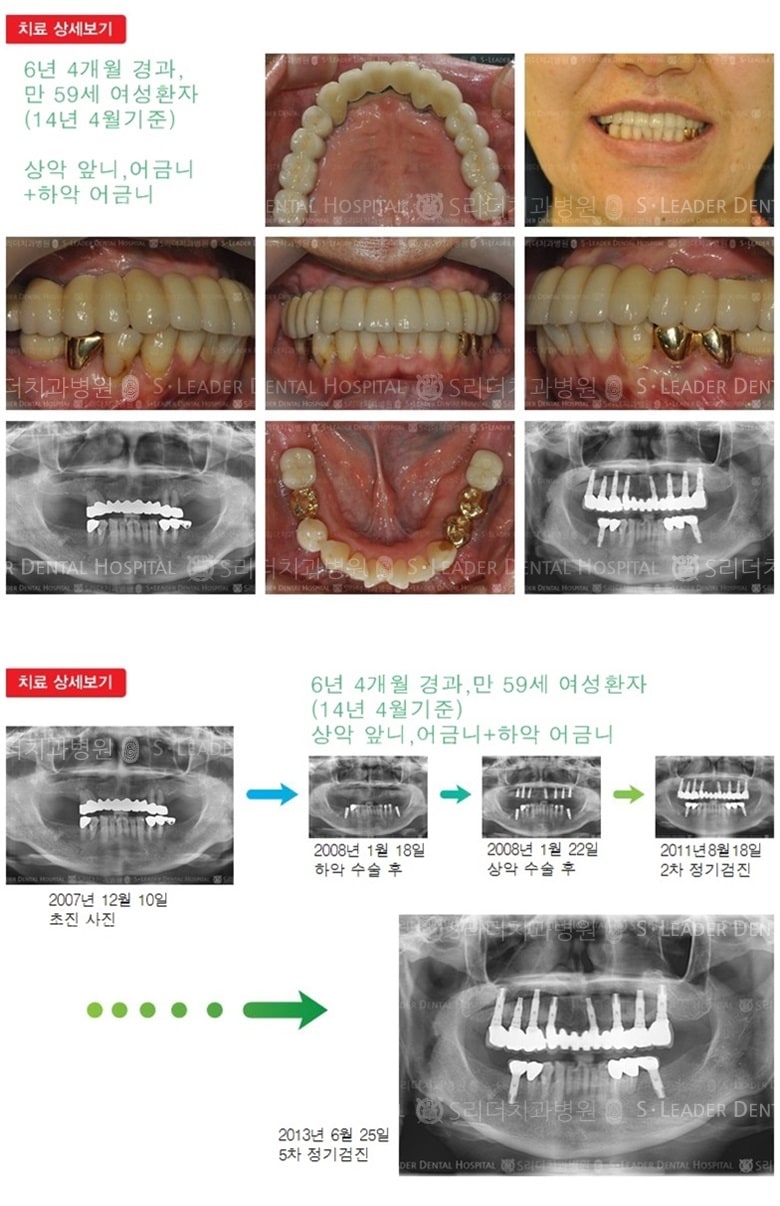 상악 전체 임플란트, 만 18년 9개월 경과 — 추가 사진 (임플란트)