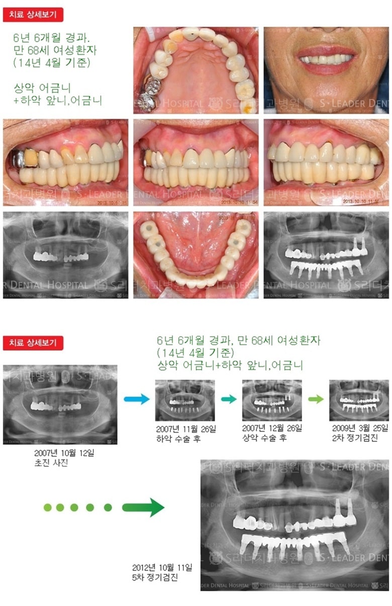 하악 전체, 상악 일부, 18년 11개월 경과 — 추가 사진 (임플란트)