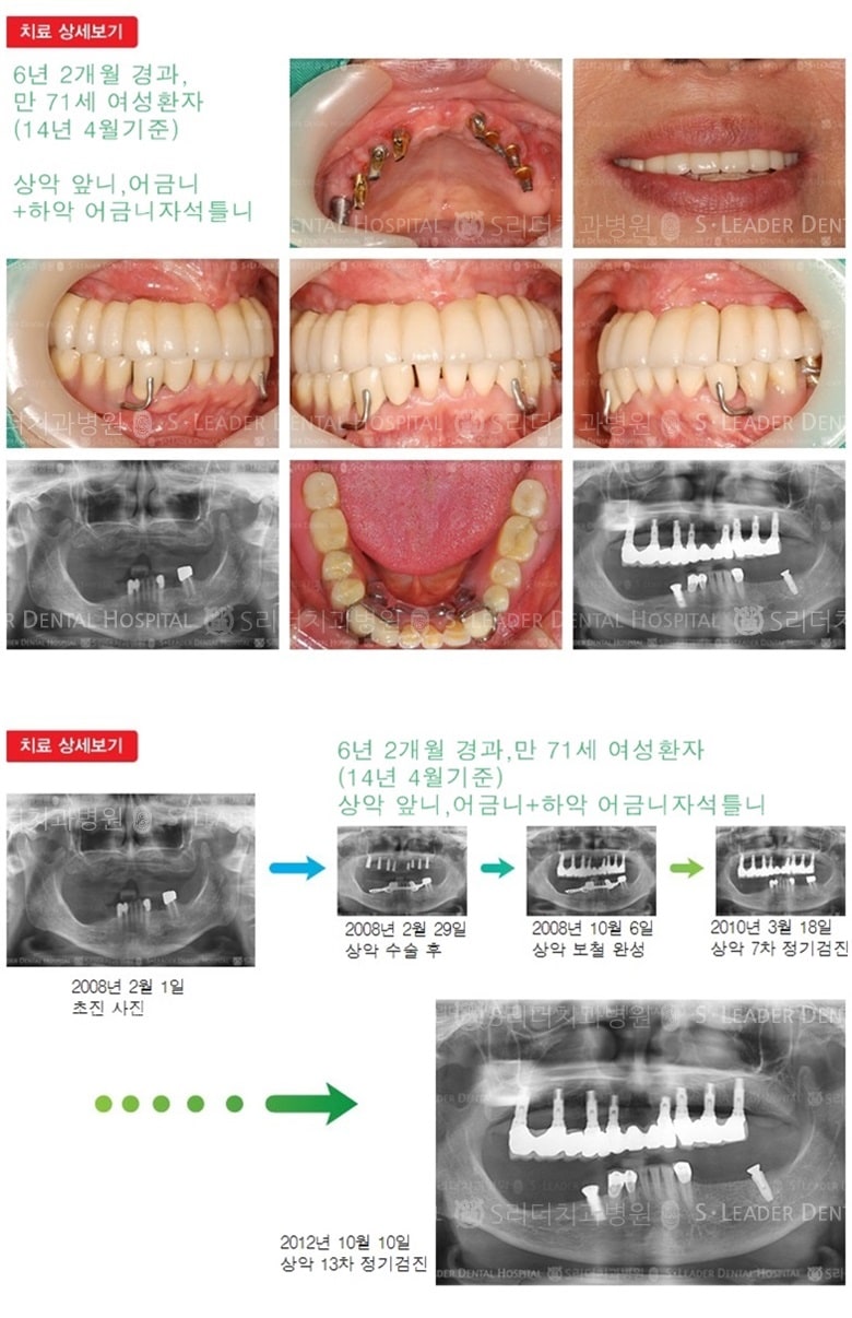 상악 전체, 하악 자석틀니,18년 7개월 경과 — 추가 사진 (임플란트)